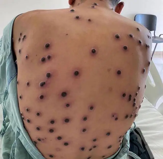 Alerta sanitário: Porto Alegre confirma primeiro caso de Mpox em 2026 às vésperas do Carnaval